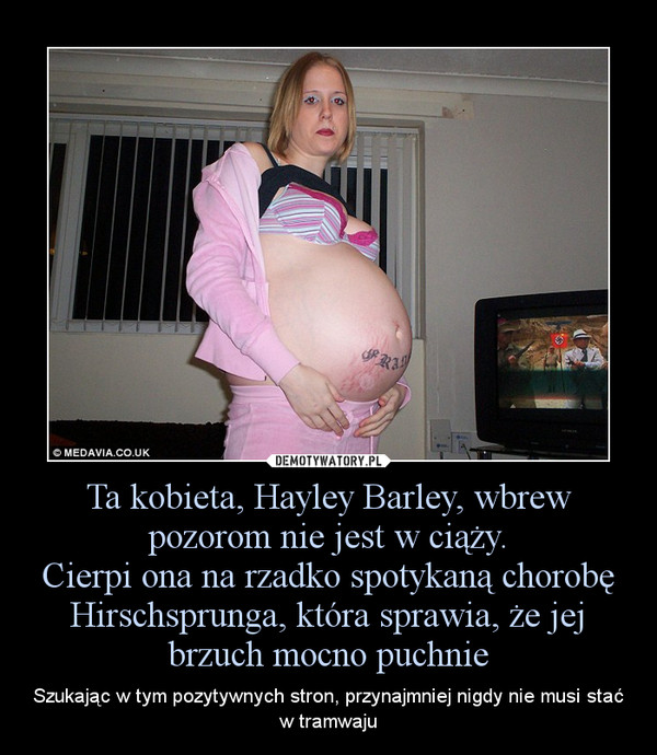 Ta kobieta, Hayley Barley, wbrew pozorom nie jest w ciąży.
Cierpi ona na rzadko spotykaną chorobę Hirschsprunga, która sprawia, że jej brzuch mocno puchnie