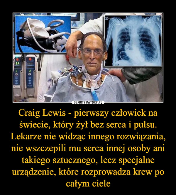 Craig Lewis - pierwszy człowiek na świecie, który żył bez serca i pulsu. Lekarze nie widząc innego rozwiązania, nie wszczepili mu serca innej osoby ani takiego sztucznego, lecz specjalne urządzenie, które rozprowadza krew po całym ciele –  